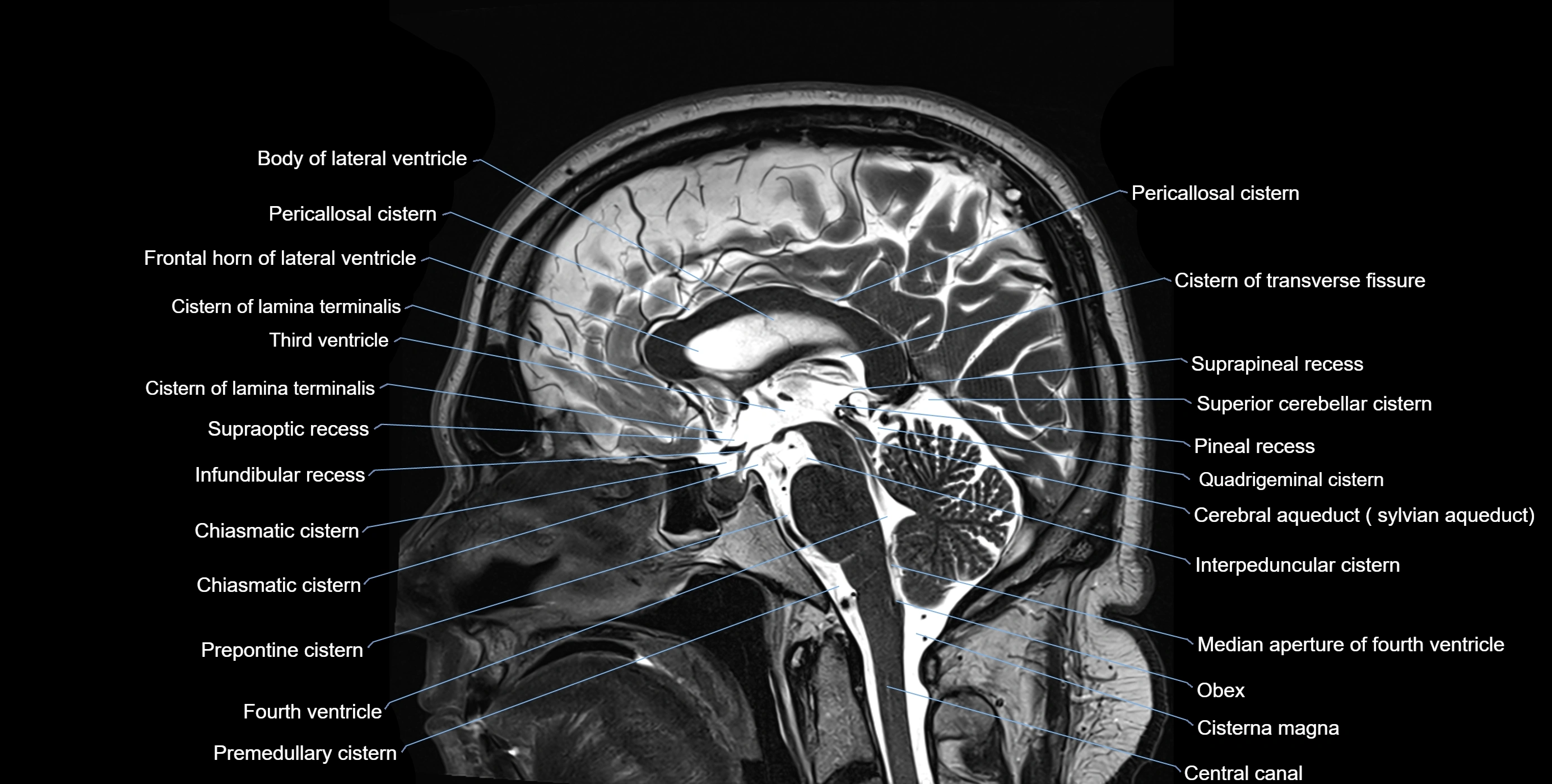 Brain cisterns  and ventricles sagittal anatomy 3T MRI image-img-00001-00029.webp